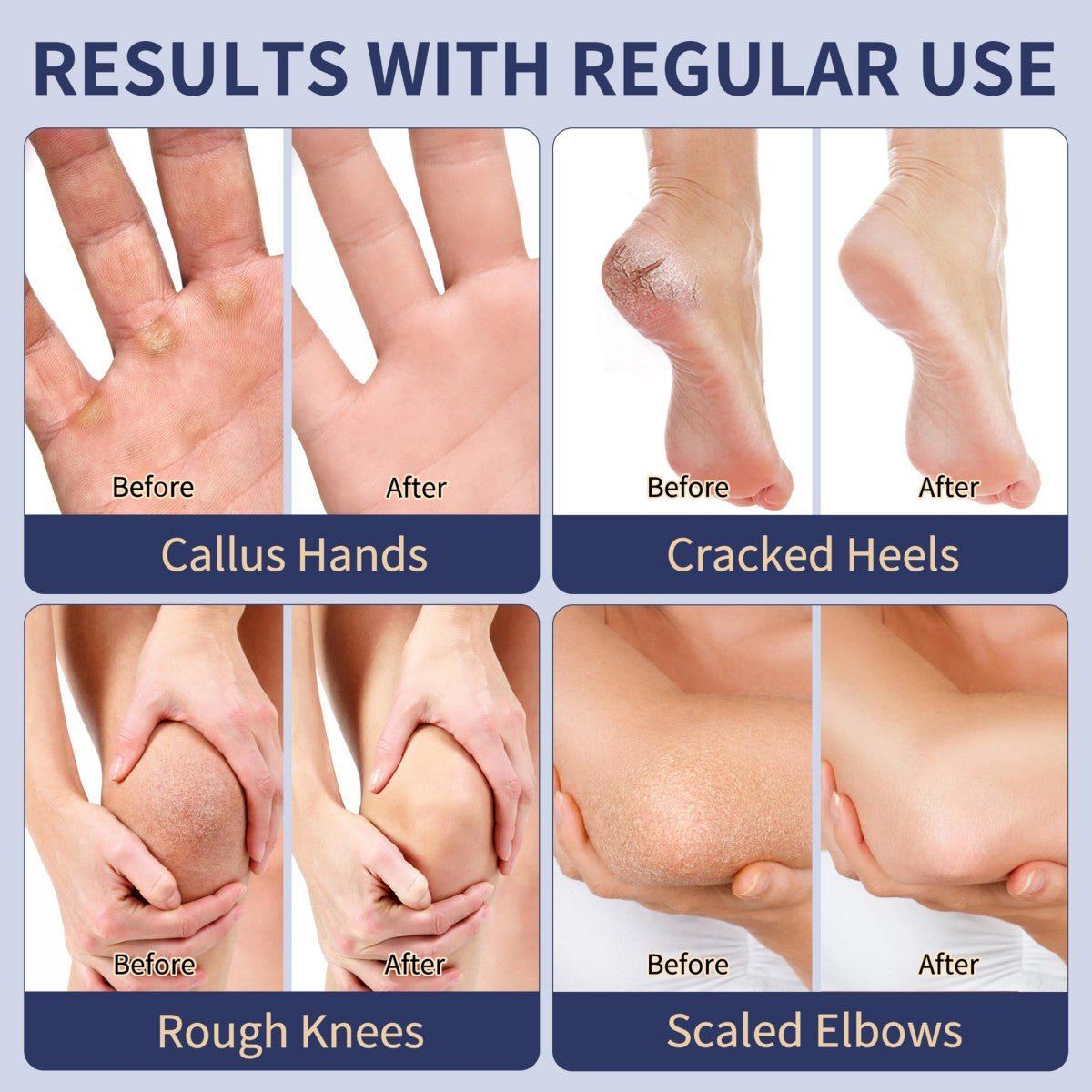 Urea Cream 40% for Feet, Salicylic Acid 2%, Callus Remover, 4.23 oz - veakoo