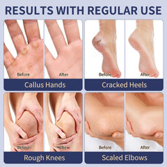 Urea Cream 40% for Feet, Salicylic Acid 2%, Callus Remover, 4.23 oz - veakoo
