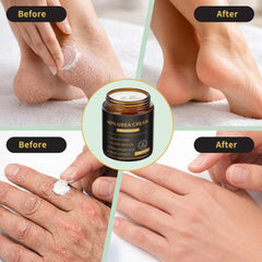 Urea Cream 40% with Salicylic Acid 2%, Dry Cracked Skin, 5.4 oz - veakoo