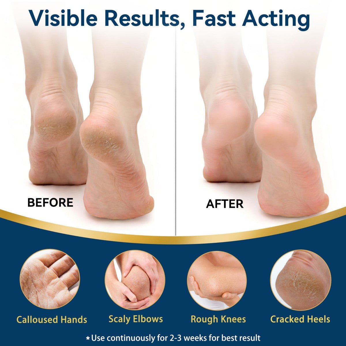 Urea Cream 40% with Salicylic Acid 2%, Foot and Hand Cream, Callus Remover, 5.29 oz - veakoo